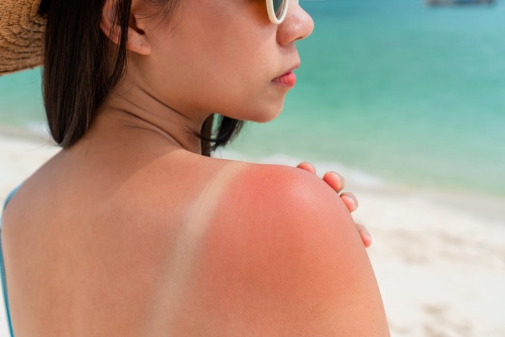 Les huiles essentielles pour apaiser un coup de soleil