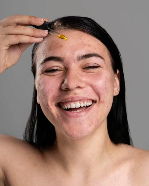 L’huile essentielle de tea tree pour dire adieu aux boutons